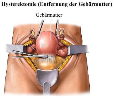 Risiken gebärmuttersenkung operation Gebärmutterentfernung (Hysterektomie)