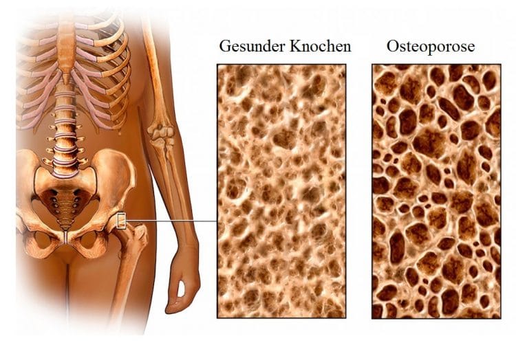 Knochen, Osteoporose