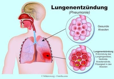 Lungenentzündung-Pneumonie