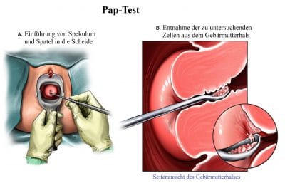Pap-Test, Spekulum, Gebärmutterhal