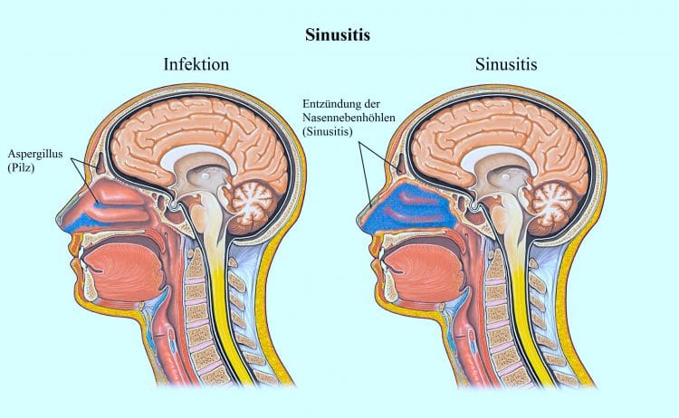 Sinusitis, Infektion, Hirnblutung, Nasennebenhöhlen