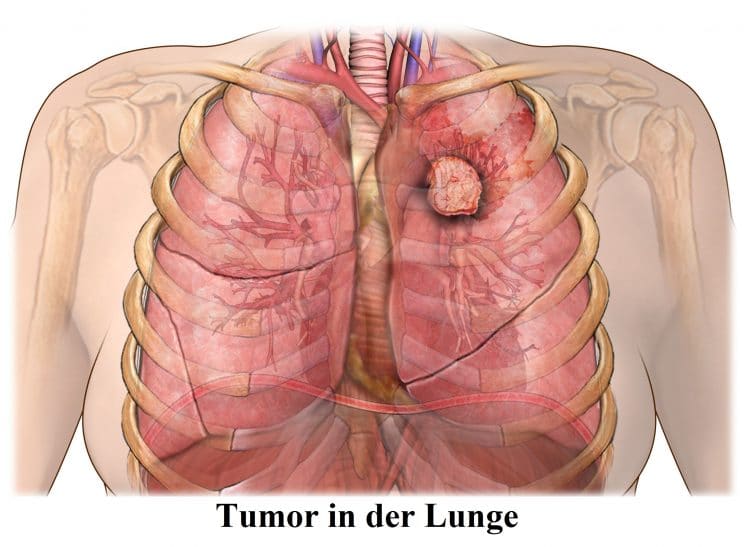 Tumor, Lunge