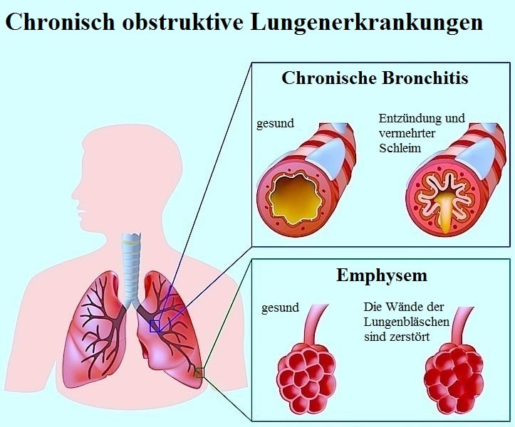 Bigstock, Chronic obstructive pulmonary Alila
