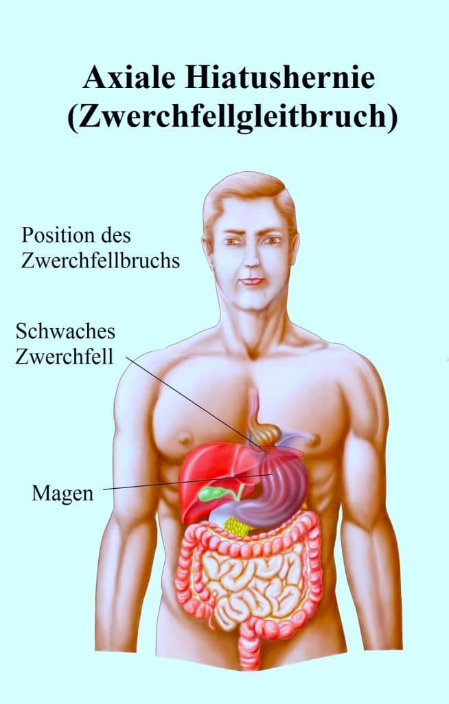 Hiatushernie-Zwerchfellgleitbruch-Speiseröhre-Magen