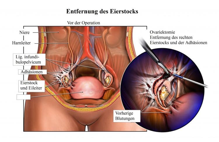 Wie lange nach gebärmutterentfernung blutungen Gebärmutterentfernung (Hysterektomie)