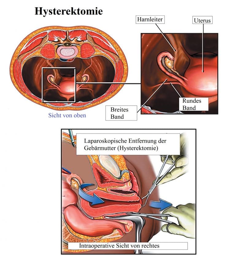 Hysterektomie-laparoskopisch-rundes-Gebärmutterband