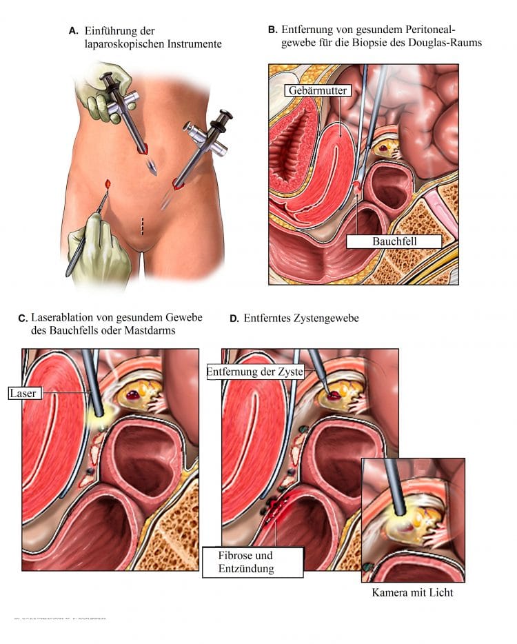 Peritonealgewebe-Biopsie-Douglas-Raum