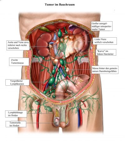 Tumor-Bauchraum-vergrößerte-Lymphknoten