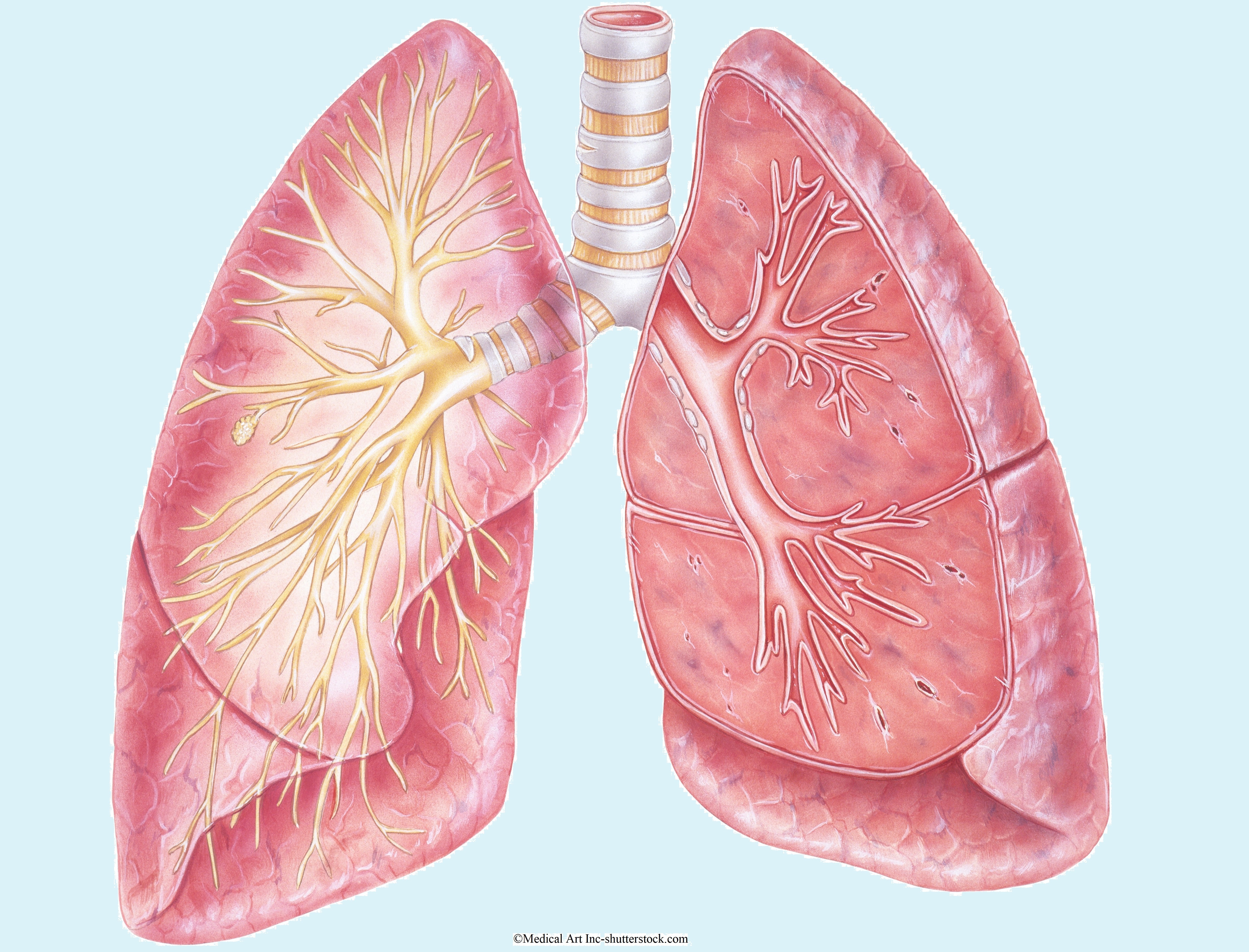  Asthma bronchiale