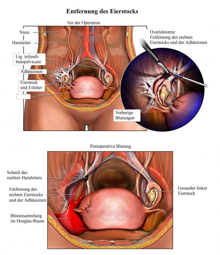 Entfernung des Eierstocks Ovariektomie