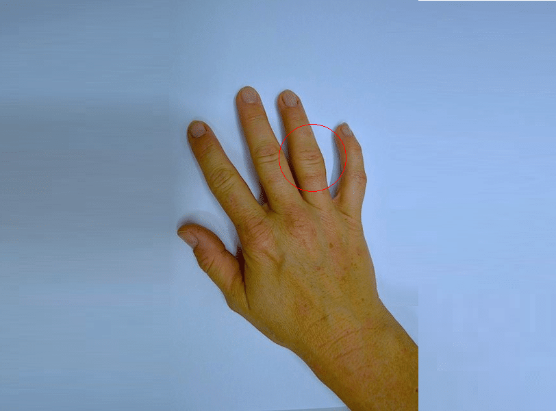 Geschwollener Finger