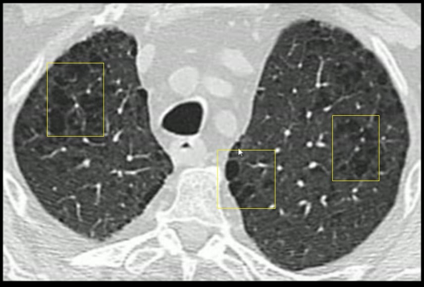 Lungenemphysem-Ursachen Symptome und Diagnose