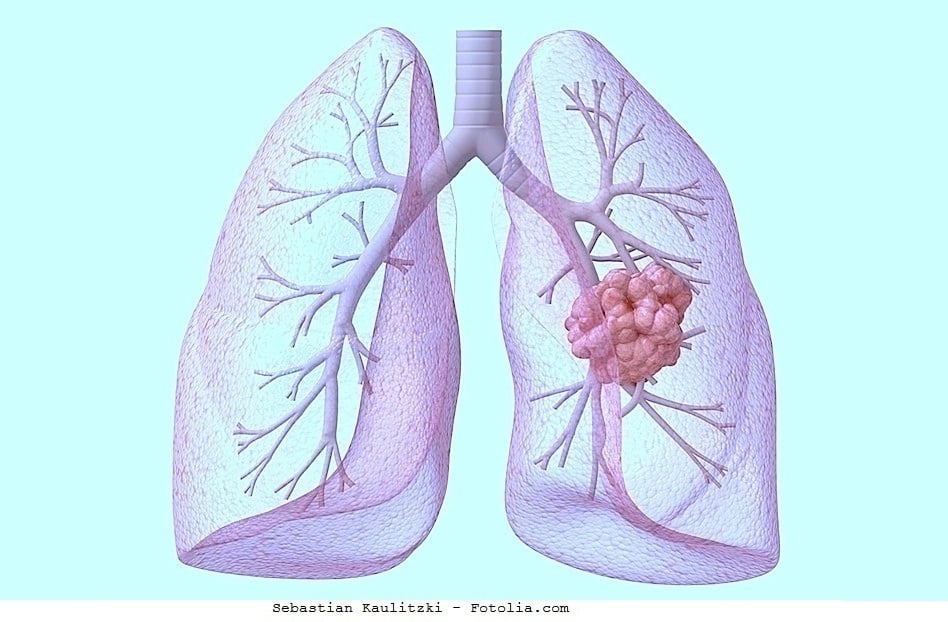 Lungenmetastasen