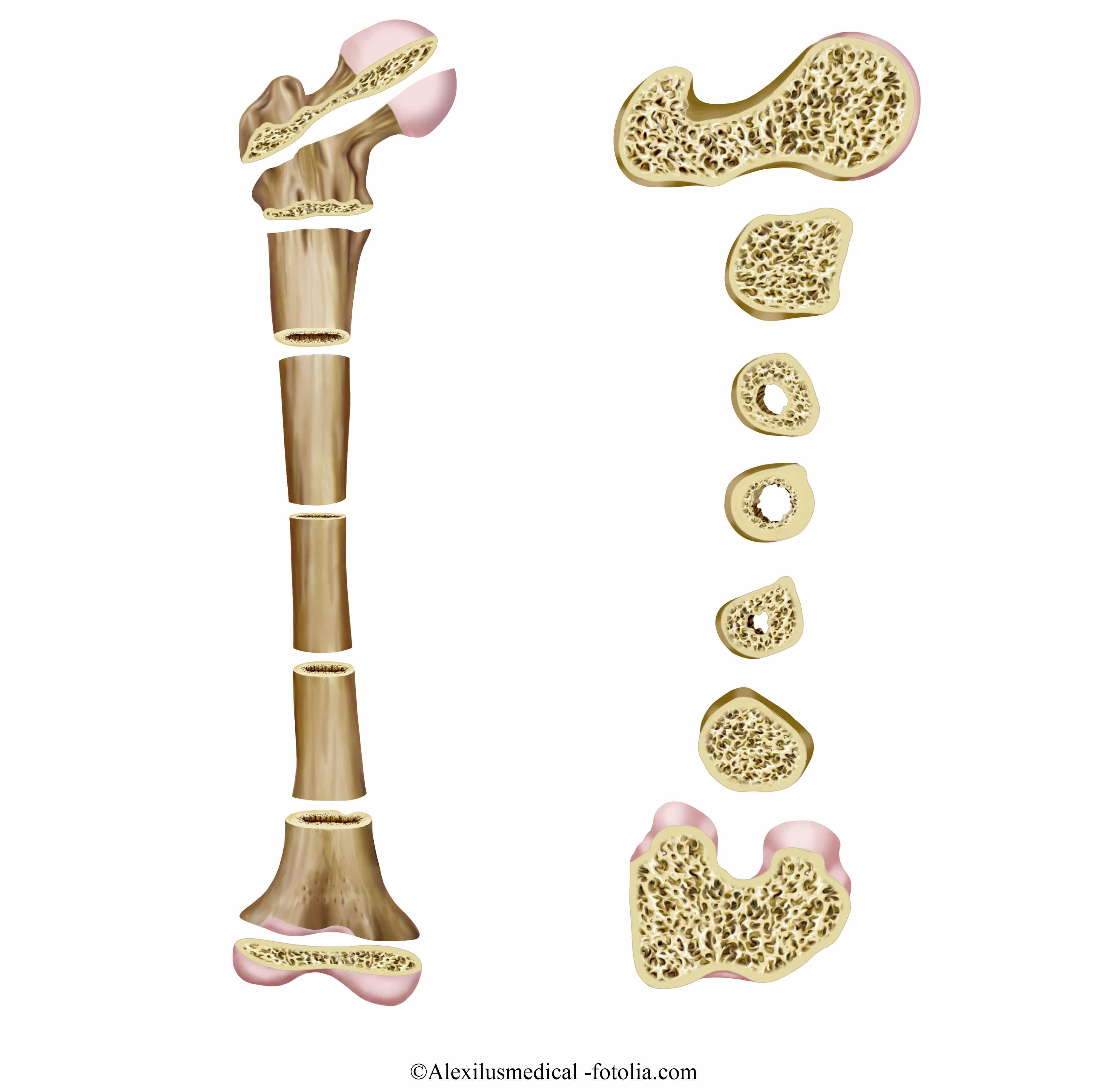 Symptome bei Osteoporose
